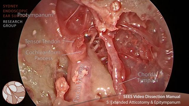 Step 5 - Sydney Endoscopic Ear Surgery Video Dissection Manual смотреть онлайн