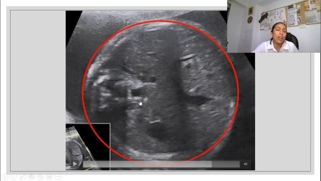 DOMINGO MÉDICO: Ecografía II-III Trimestre 2021 смотреть онлайн