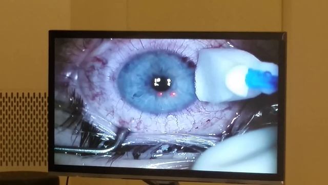 Laser eye surgery (FEMTO LASIK) смотреть онлайн
