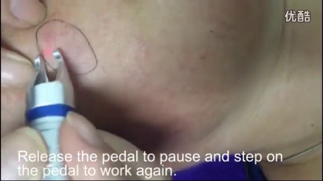980nm Diode Laser Vascular Removal Machine Treatment