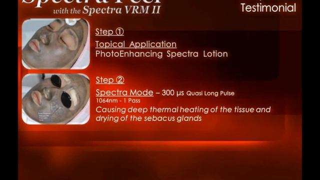 Spectra Laser Peel for Acne & Acne Scars Video Testimonial смотреть онлайн
