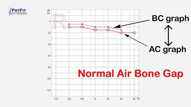 How To Read Audiogram - Explained In Hindi || सुनाई की जाँच (Audiometry Test) रिपोर्ट को कैसे पढ़ें