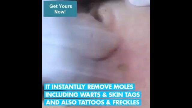 MOLE, SKIN TAG, SPOTS REMOVAL PEN смотреть онлайн