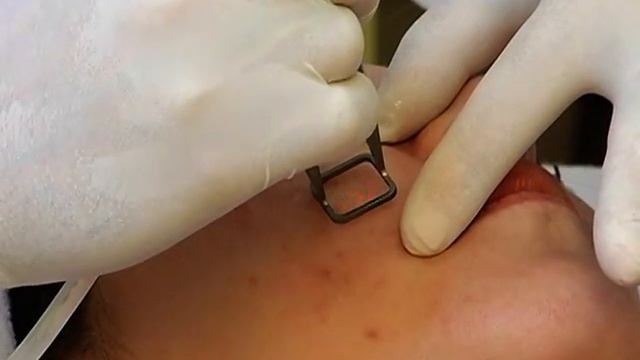 Điều trị sẹo mụn bằng PIXEL PERFECT (Fractional CO2)-MARIANNA medical laser skin care смотреть онлайн