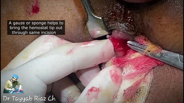 Chronic Anal Fissure | Sentinel Piles | Lateral Internal Sphincterotomy - Dr Tayyab Riaz Ch смотреть онлайн