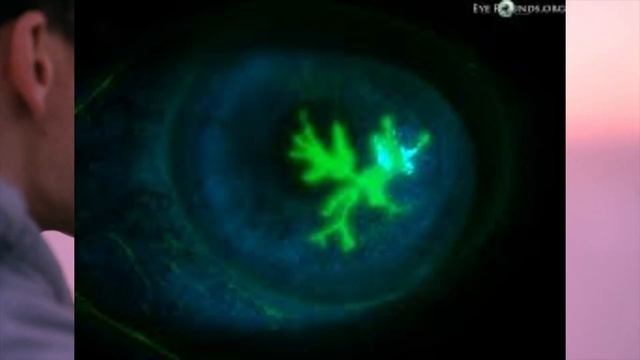 ভাইরাল কেরাটাইটিস কি? | Dr.Razeet | Viral Keratitis Treatment | Herpes Simplex Virus смотреть онлайн