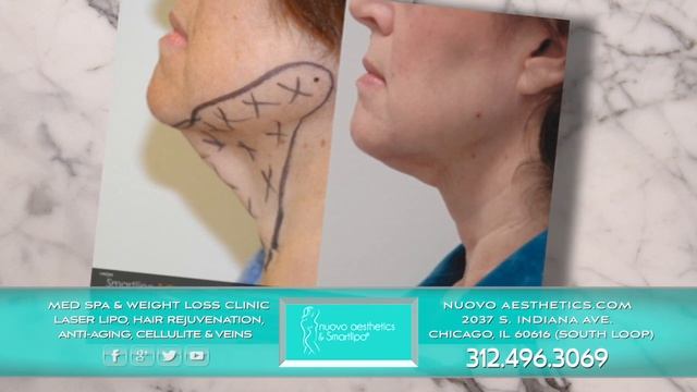 Smart Lipo Chicago - Laser Liposuction Chicago South Loop смотреть онлайн