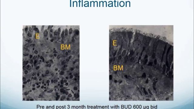 What is the Asthma COPD Overlap Syndrome (ACOS) with Dr Kenneth Chapman смотреть онлайн