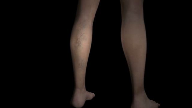 Endovenous Laser Treatment (EVLT) смотреть онлайн