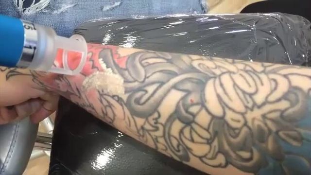 ELIMINACION DE TATUAJE CON NUEVO LASER INK HUNTER MASTER 2015 смотреть онлайн