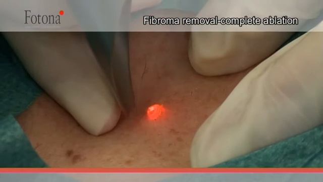 SEM-FOTONA-Laser_ErYag_Odstraneni_vyrustku2.mpg смотреть онлайн