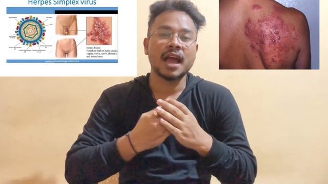 Herpes Disease kio hoi ? Genital Herpes | KTG AMC And Hospital, Bangalore | #the_daily_beat123 смотреть онлайн