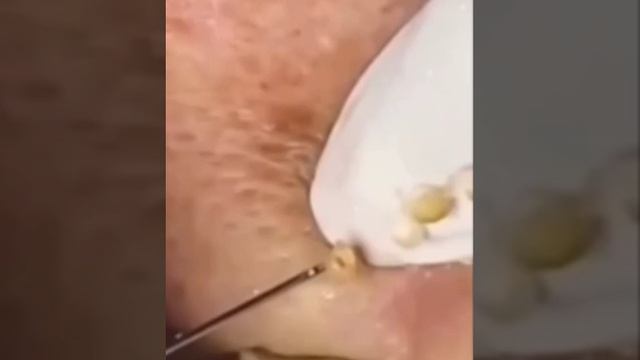 Чистка лица. смотреть онлайн