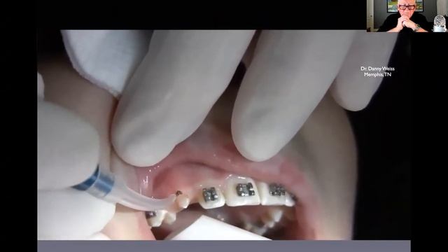 Why the Spectralase is the best diode laser in the world смотреть онлайн