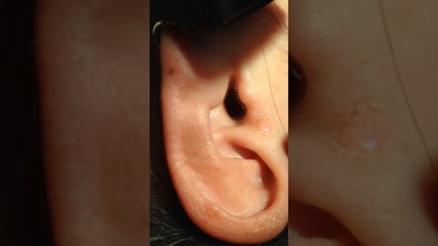 FOTONA SP DYNAMIS R08: laser removal of intradermal nevus смотреть онлайн