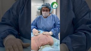 Липосакция жирового горбика, удалено 1500 мл жира. VASER LIPO