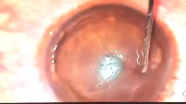 Management Of Traumatic Displaced Lasik Flap