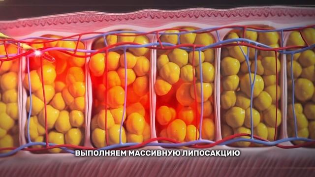 ЛИПОСАКЦИЯ, КАК СПОСОБ СНИЖЕНИЯ ВЕСА смотреть онлайн