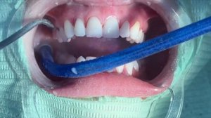 Профессиональная гигиена полости рта. Все этапы!