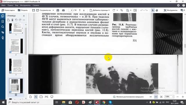 528 Гиперпаратиреоз +++