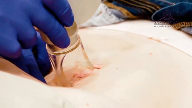 Лазерная шлифовка в клинике SarMedical