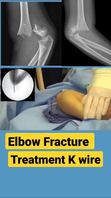 Elbow fractures treatment for five years child смотреть онлайн