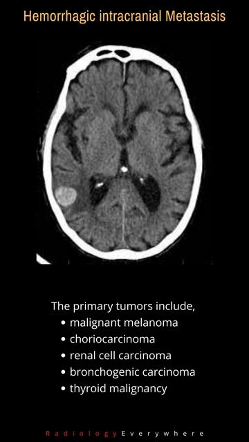 Hemorrhagic intracranial Metastasis | Radiology Tutorials | #shorts | #radiologyshorts смотреть онлайн