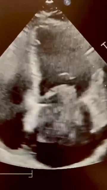 Left Atrial Myxoma #echocardiography #echocardiogram #cardiology