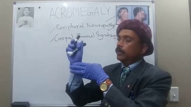 ACROMEGALY