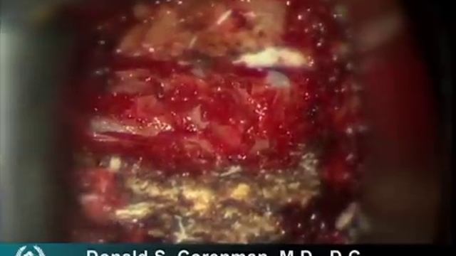 Anterior Cervical Decompression And Fusion (ACDF) | Live Spine Surgery Video | Spine Surgeon