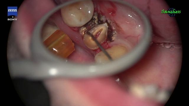 Apical crown lengthening 34 смотреть онлайн