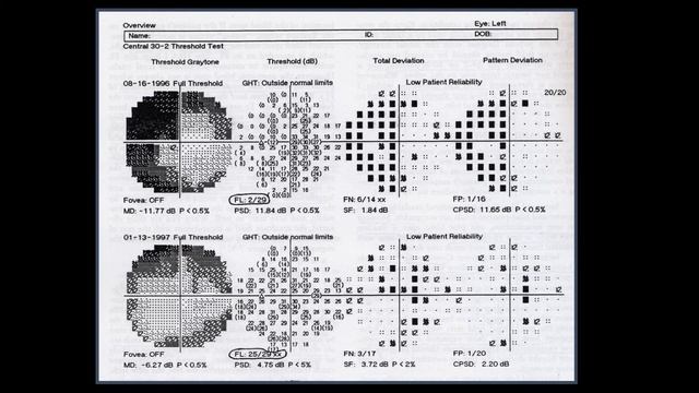 3- Visual field interpretation (Reliability indices in Humphrey perimeter). смотреть онлайн