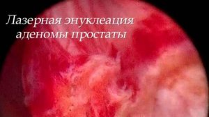 Лазерная энуклеация аденомы простаты