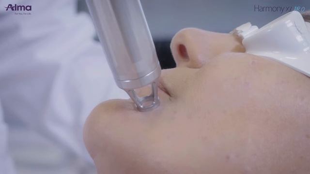 Harmony XL Pro Clearlift Q switched 1064 CVD 3 5mm tips Superficial Pigmented Lesions | ACG | Alma смотреть онлайн