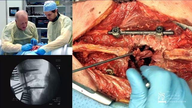 Posterior Decompression of a Burst Fracture - Jens R Chapman, MD смотреть онлайн