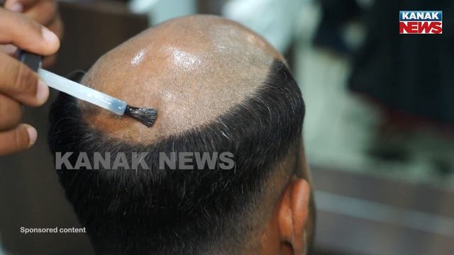 UltimoCapelliHair – Hair Replacement Center | The Leading Businesses In The Hair Transplant Clinics