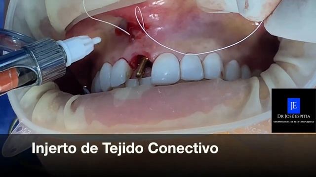 implante pos extraccion con carga inmediata смотреть онлайн