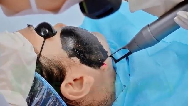Q Switched Nd YAG Laser Carbon Peeling Facial Peel Guidance смотреть онлайн