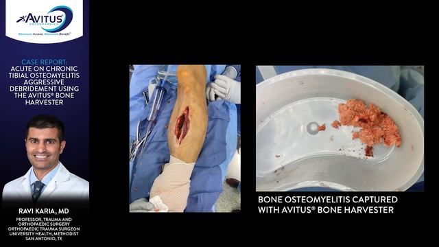 Dr. Karia Presents [TRAUMA] Aggressive Debridement of Tibial Osteomyelitis смотреть онлайн