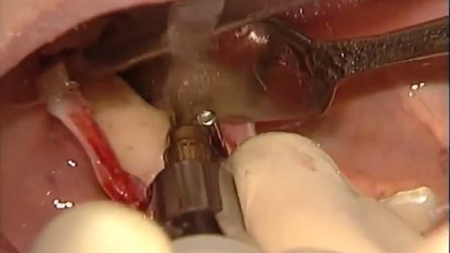 Implant Site Prep 3 смотреть онлайн