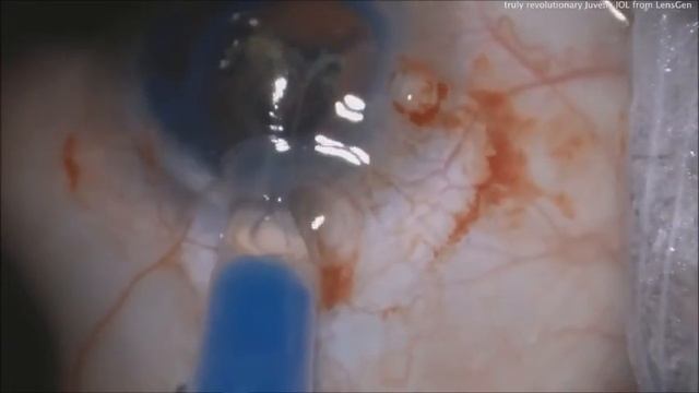 Presbyopic IOL offers novel design смотреть онлайн