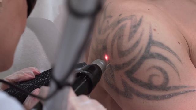 The PicoSure Laser смотреть онлайн