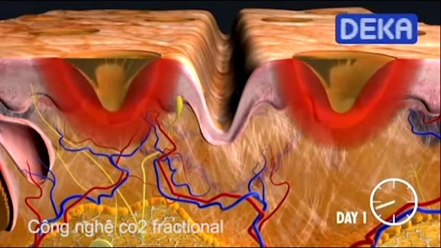 Cơ Chế Hoạt Động Laser CO2 Fractional Và Lăn Kim Đặc Trị Sẹo Rỗ, Lỏm Tại Jenna Thanh смотреть онлайн
