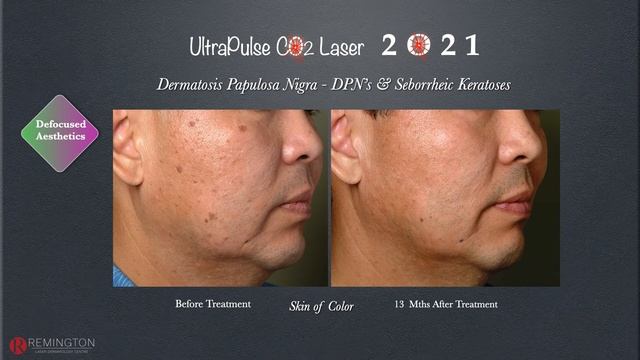 CO2 Laser Treatments for Benign Skin Lesions смотреть онлайн