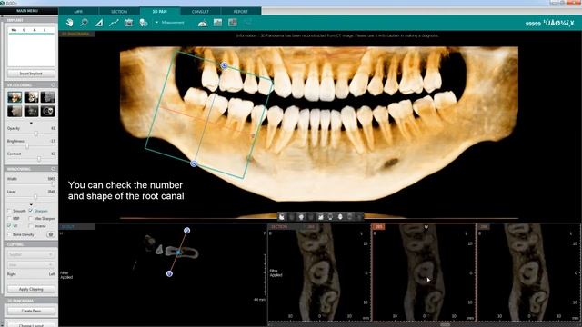 Endo Analysis in 3D PAN | Ez3D-i | Vatech смотреть онлайн