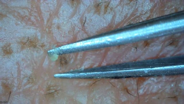 0067 角栓抜き 額