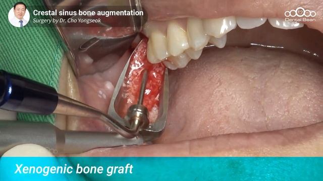 #17 Implant Placement With Crestal Sinus Bone Augmentation [Dr. Cho Yongseok]
