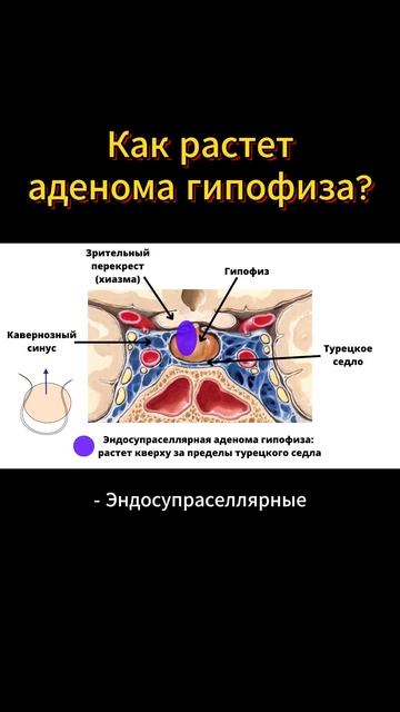 Где и как развивается АДЕНОМА ГИПОФИЗА? #меднавигатор #онкология #рак #опухоль #онколог #мозг смотреть онлайн