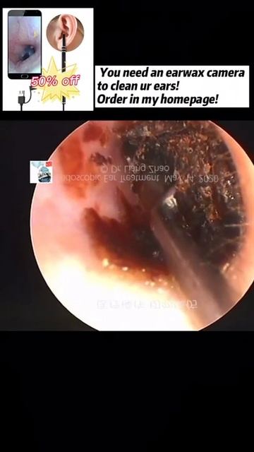 Best Ear Wax Removal & Extraction with Vacuum Remover 真空リムーバーによるにきびの除去と抽出 269 смотреть онлайн