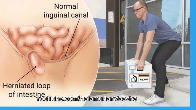 குடலிறக்கம் | வீட்டு மருத்துவம் என்ன? | Home remedies for hernia in tamil смотреть онлайн